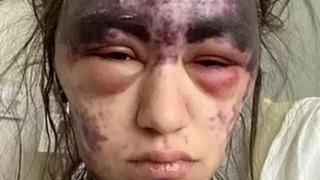 Tedavi için gittiği hastanede kabusu yaşadı! 10 dakika içinde kör oldu, çenesi kilitlendi: Vücudunda morluklar oluştu