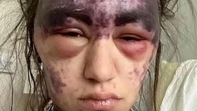 Tedavi için gittiği hastanede kabusu yaşadı! 10 dakika içinde kör oldu, çenesi kilitlendi: Vücudunda morluklar oluştu