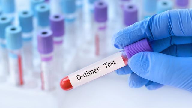 D dimer nedir, en yüksek kaç olmalı? D Dimer yüksekliği ne anlama gelir?