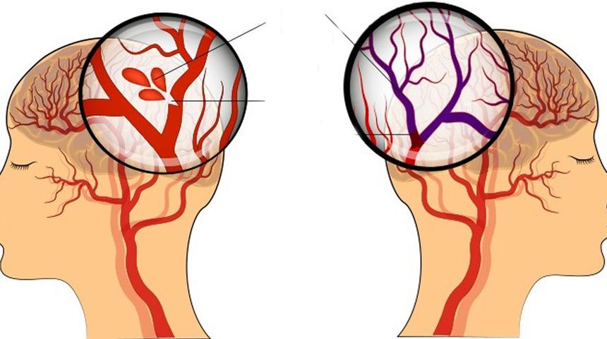 Kadınları kanserden çok bu hastalık öldürüyor!