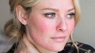 Soğuk tetikliyor! Yüzünüzü kızartan neden: rozasea