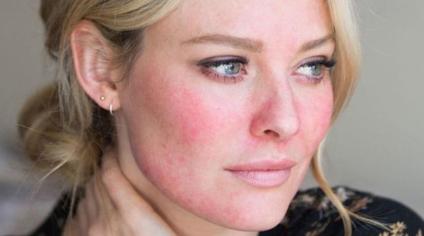 Soğuk tetikliyor! Yüzünüzü kızartan neden: rozasea