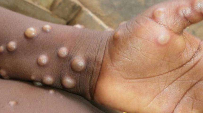 DSÖ duyurdu! 'Afrika’da bu yıl 30 bin şüpheli M-çiçeği virüsü vakası görüldü'