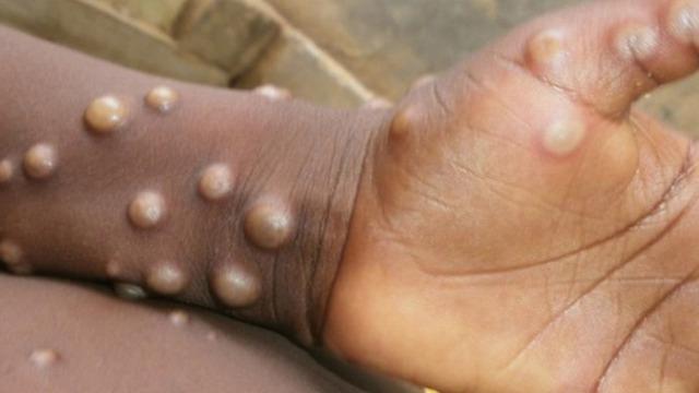 DSÖ duyurdu! 'Afrika’da bu yıl 30 bin şüpheli M-çiçeği virüsü vakası görüldü'