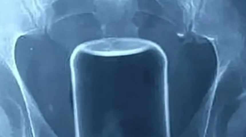 Doktorlar hastanın anüsünde sıkışan cam kavanozu çıkartabilmek için saatlerce mücadele ettiler! "Parçalanıp öldürme riski çok yüksekti"