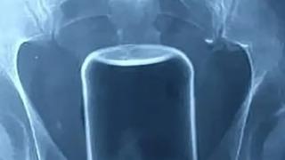 Doktorlar hastanın anüsünde sıkışan cam kavanozu çıkartabilmek için saatlerce mücadele ettiler! Parçalanıp öldürme riski çok yüksekti