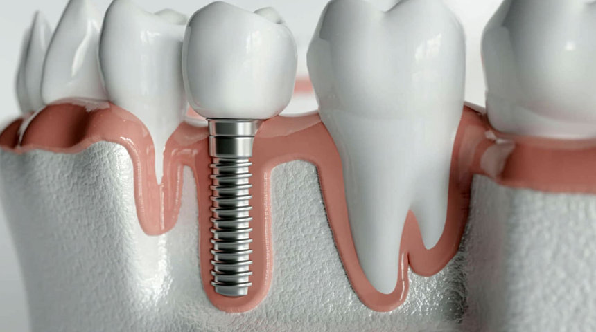 İmplant tedavisinde bu ayrıntılara dikkat edin!