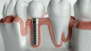 İmplant tedavisinde bu ayrıntılara dikkat edin!