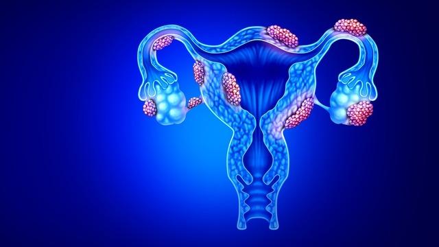 Kadınlarda son dönemlerde artış gösterdi! Tedavi edilmezse sonucu kötü olabilir