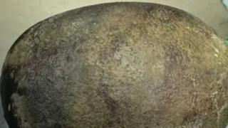 Karın ağrısı şikayetiyle doktora gitti! Mesanesinden çıkartıldı... Doktorlar bile inanamadı: 20 yıldır çalışıyorum böyle bir şey görmedim