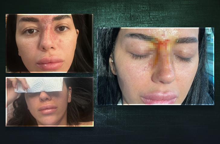 Güzelleşmek isterken hayatı karardı! Basit işlem körlüğe neden oldu! Saatlerce bilinci kapandı