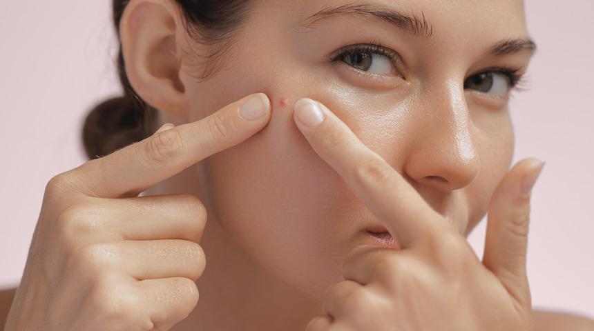 Sivilceye ne iyi gelir? Sivilceyi en hızlı ne yok eder?