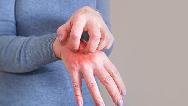 Uyuza ne iyi gelir? Uyuz hastalığı en hızlı nasıl geçer? Uyuz için evde ne yapılabilir?