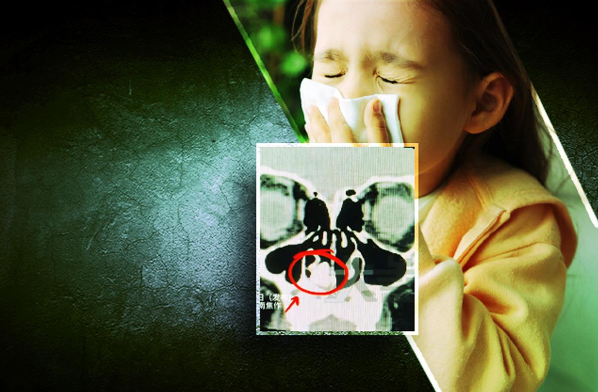 Yıllarca k&ouml;t&uuml; koku şikayeti olan &ccedil;ocuk hastanelik oldu! Burnundan &ccedil;ıkan cisim herkesi şaşırttı 