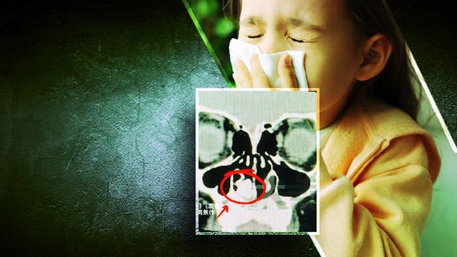 Yıllarca kötü koku şikayeti olan çocuk hastanelik oldu! Burnundan çıkan cisim herkesi şaşırttı 