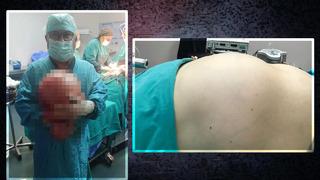Karnı 9 aylık hamile gibiydi! İçinden 10 kiloluk kitle çıktı... Doktor bile gözlerine inanamadı