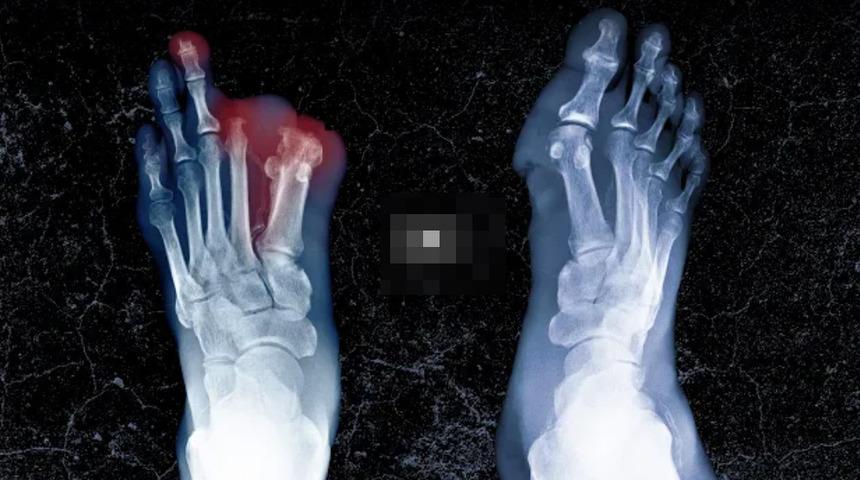 Arkadaşının bir gece öncesinde kalan yemeğini yedi! Ertesi gün hastanelik oldu... Doktorlar uzuvlarını kesmek zorunda kaldı