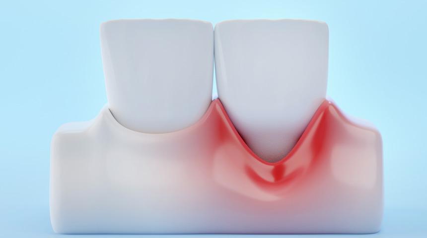 Diş eti çekilmesine ne iyi gelir? Tuzlu su diş eti çekilmesine iyi gelir mi?