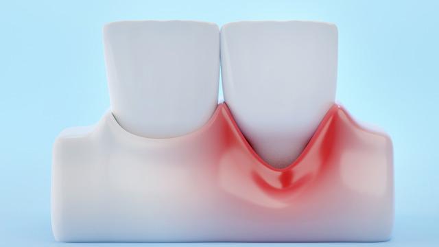 Diş eti çekilmesine ne iyi gelir? Tuzlu su diş eti çekilmesine iyi gelir mi?
