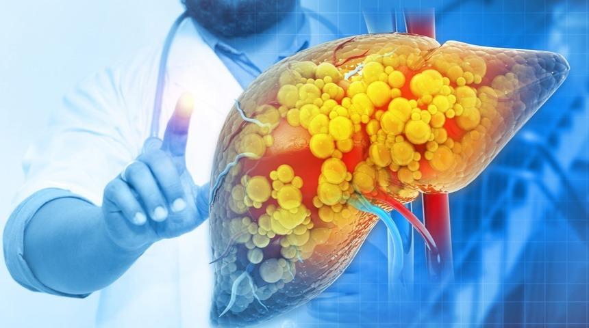 Sessiz tehlike: Sinsi bir şekilde ilerliyor! Siroz riskini artırıyor 'Türkiye’de her 3 kişiden birinde var'