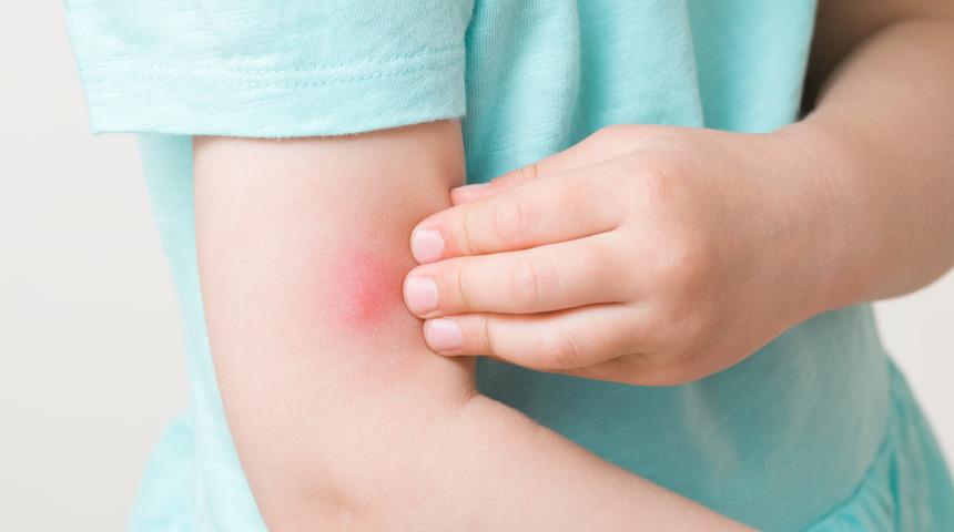 Sinek ısırığına ne iyi gelir? Kolonya sinek ısırığına iyi gelir mi? Sinek ısırığına ne krem sürülür?