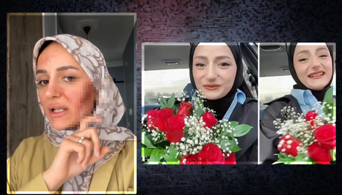 Yüzü yandı mı? Amin Reis son halini paylaştı, nedenini açıkladı!