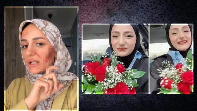 Yüzünün yandığı iddia edilmişti! Amin Reis Gizem Yıldız son halini paylaştı, nedenini açıkladı!