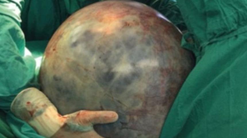 Meksikalı kadının karnından 34 kiloluk &lsquo;rekor&rsquo; t&uuml;m&ouml;r &ccedil;ıktı