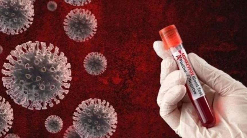 M Çiçeği Virüsü 18 ülkeye yayıldı! Ölenlerin sayısı bini geçti... Belirtileri ve tedavi yöntemi nedir?