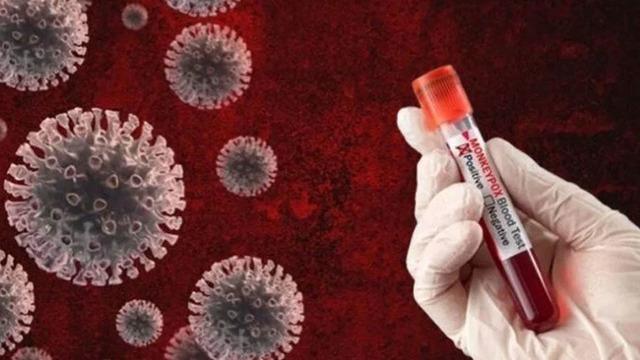 M Çiçeği Virüsü 18 ülkeye yayıldı! Ölenlerin sayısı bini geçti... Belirtileri ve tedavi yöntemi nedir?