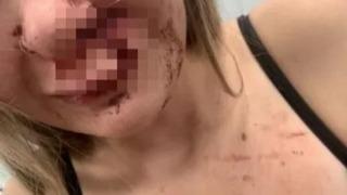 Önce uygunsuz yorumlar yaptı! Sonrasında yaşanan tartışmada genç kızın yüzünü ısırdı: 50 dikiş, 2 buçuk saatlik ameliyat