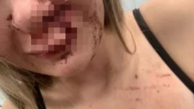 Önce uygunsuz yorumlar yaptı! Sonrasında yaşanan tartışmada genç kızın yüzünü ısırdı: 50 dikiş, 2 buçuk saatlik ameliyat