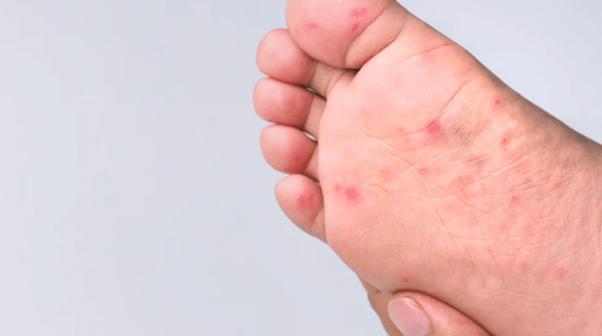 Uzmanı uyardı: Okullarda hızla yayılan tehlike! Temasla bulaşıyor, deride pul pul dökülme ile kendini gösteriyor