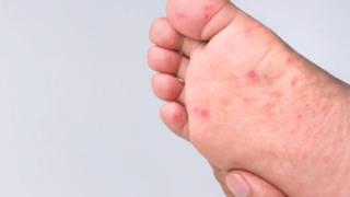 Uzmanı uyardı: Okullarda hızla yayılan tehlike! Temasla bulaşıyor, deride pul pul dökülme ile kendini gösteriyor