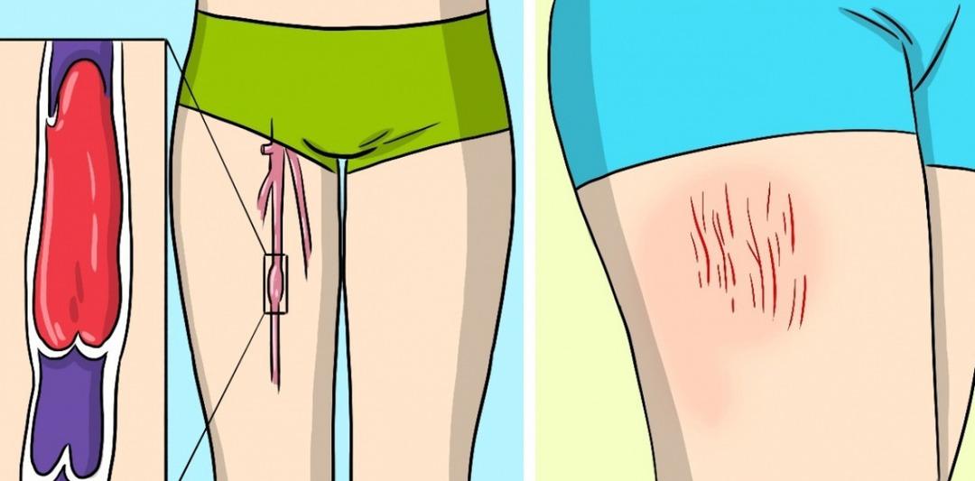 Kan pıhtısının uyarı işaretleri! &Ouml;nemsenmemesi &ouml;l&uuml;me neden oluyor