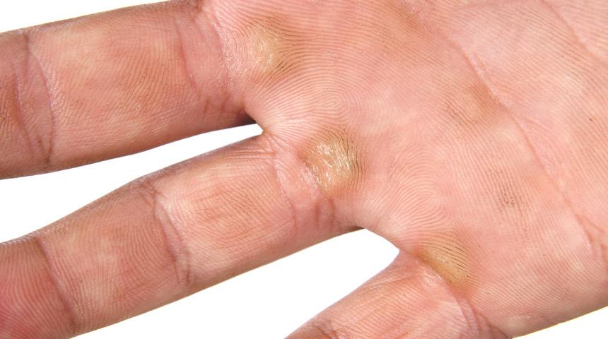 Nasıra ne iyi gelir, nasır nasıl yok edilir? Vazelin nasıra iyi gelir mi?