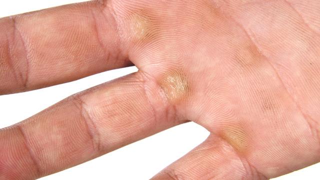 Nasıra ne iyi gelir, nasır nasıl yok edilir? Vazelin nasıra iyi gelir mi?