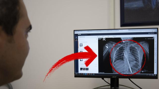 Aydın'da sıra dışı vaka: 18 santimlik çatal yuttu, doktorlar şaştı kaldı! Bilimsel makaleye konu olacak...