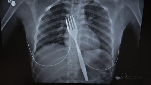 Doktor bile inanamadı... Tam 18 santimetre! Böyle bir cisim yutulması ile karşılaşmamıştım.