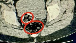 Muayenede tespit edildi! Makatından çıkanlar şaşkına çevirdi