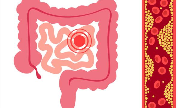 Soluduğumuz havadan nerede yaşadığımıza kadar bile etkiliyor... Bağırsak sağlığı için uzman isim uyardı! Kanser riskini azaltıyor”