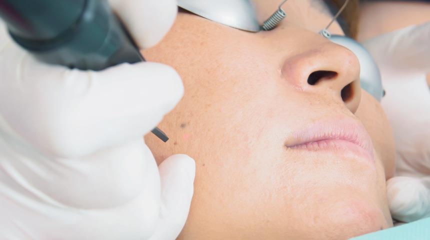 Q-Switch lazer nedir, ne işe yarar? Q-Switch lazer nasıl uygulanır?