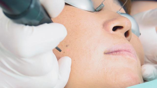 Q-Switch lazer nedir, ne işe yarar? Q-Switch lazer nasıl uygulanır?