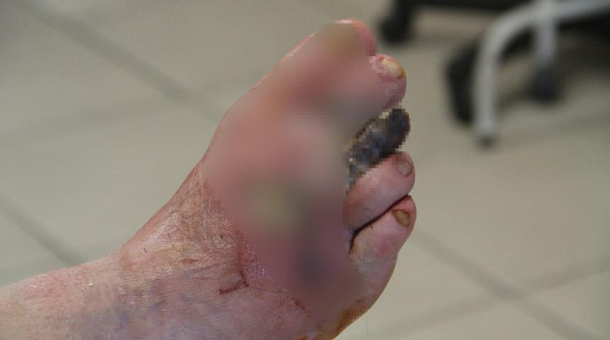 Kansızlık zannediliyor ama... Ellerde üşüme o kadar da masum değilmiş! Parmak kaybettiren tehlikeli hastalığın habercisi olabilir