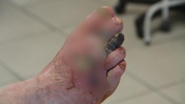 Kansızlık zannediliyor ama... Ellerde üşüme o kadar da masum değilmiş! Parmak kaybettiren tehlikeli hastalığın habercisi olabilir