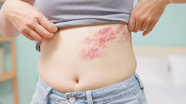 Stres ve kaygı gençlerde ‘Zona' görülmesini arttırdı! Kalp kriziyle karıştırılıyor 