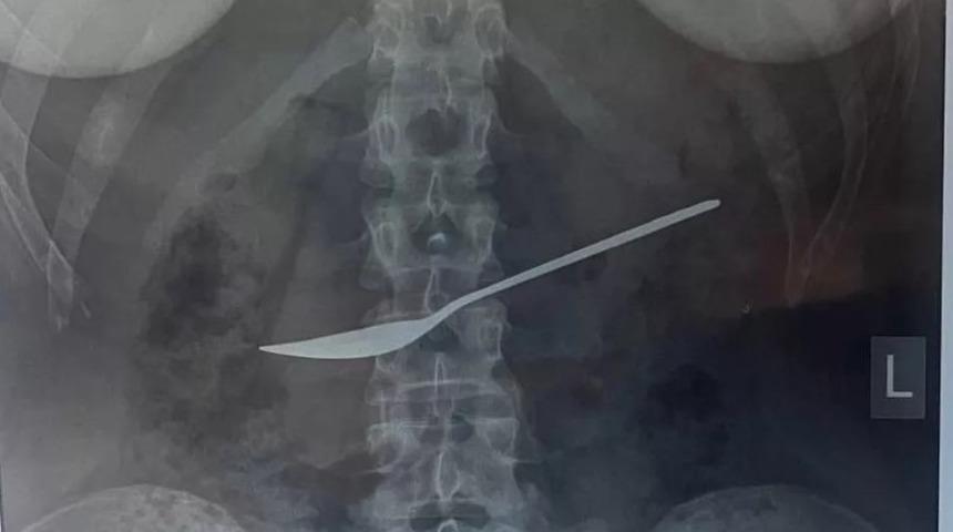 Doktorları bile şaşkına çevirdi! Karnı ağrıdığı için hastaneye giden kadının midesinden 20 cm'lik kaşık çıkartıldı