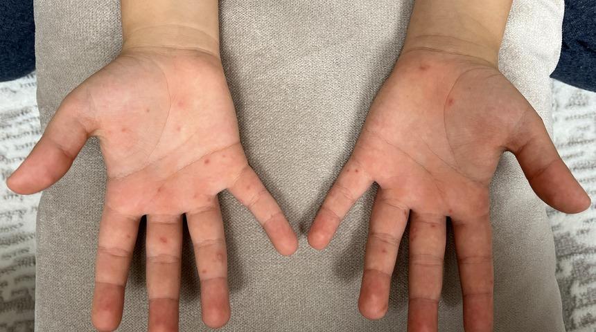 Uzman isim uyardı: Bu hastalık hafife alınmamalı! Çocuklarda sıkça görülüyor, yetişkinleri de etkiliyor