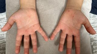 Uzman isim uyardı: Bu hastalık hafife alınmamalı! Çocuklarda sıkça görülüyor, yetişkinleri de etkiliyor