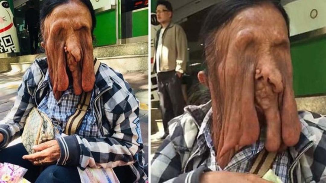 Y&uuml;z&uuml; eriyor, g&ouml;zleri g&ouml;rm&uuml;yor... Ama tedaviyi reddediyor! Bakın neden?